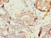 Immunohistochemistry of paraffin-embedded human breast cancer using CSB-PA624102ESR1HU at dilution of 1:100