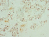 Immunohistochemistry of paraffin-embedded human bladder cancer using CSB-PA005272DSR1HU at dilution of 1:100