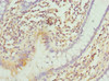 Immunohistochemistry of paraffin-embedded human colon cancer using CSB-PA622653DSR1HU at dilution of 1:100