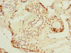 Immunohistochemistry of paraffin-embedded human breast cancer using CSB-PA822259ESR2HU at dilution of 1:100 Immunohistochemistry of paraffin-embedded human breast cancer using CSB-PA822259ESR2HU at dilution of 1:100