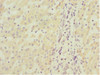 Immunohistochemistry of paraffin-embedded human liver cancer using CSB-PA013787ESR1HU at dilution of 1:100