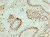 Immunohistochemistry of paraffin-embedded human breast cancer using CSB-PA007596DSR2HU at dilution of 1:100