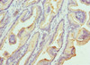 Immunohistochemistry of paraffin-embedded human prostate cancer using CSB-PA012447ESR1HU at dilution of 1:100
