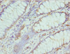 Immunohistochemistry of paraffin-embedded human colon cancer using CSB-PA005616ESR2HU at dilution of 1:100