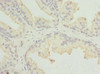 Immunohistochemistry of paraffin-embedded human prostate cancer using CSB-PA853268ESR2HU at dilution of 1:100 Immunohistochemistry of paraffin-embedded human prostate cancer using CSB-PA853268ESR2HU at dilution of 1:100