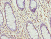 Immunohistochemistry of paraffin-embedded human colon cancer using CSB-PA023106DSR2HU at dilution of 1:100