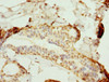 Immunohistochemistry of paraffin-embedded human breast cancer using CSB-PA890657ESR1HU at dilution of 1:100