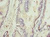 Immunohistochemistry of paraffin-embedded human prostate cancer using CSB-PA020565ESR2HU at dilution of 1:100