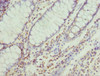 Immunohistochemistry of paraffin-embedded human colon cancer using CSB-PA614389ESR1HU at dilution of 1:100