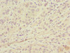 Immunohistochemistry of paraffin-embedded human liver cancer using CSB-PA013216ESR1HU at dilution of 1:100