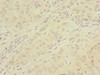 Immunohistochemistry of paraffin-embedded human liver cancer using CSB-PA857450ESR1HU at dilution of 1:100