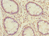 Immunohistochemistry of paraffin-embedded human colon cancer using CSB-PA896505DSR1HU at dilution of 1:100