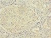 Immunohistochemistry of paraffin-embedded human lung cancer using CSB-PA896505DSR2HU at dilution of 1:100