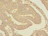 Immunohistochemistry of paraffin-embedded human endometrial cancer using CSB-PA020419ESR2HU at dilution of 1:100
