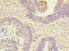 Immunohistochemistry of paraffin-embedded human ovarian cancer using CSB-PA001833ESR1HU at dilution of 1:100