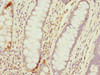 Immunohistochemistry of paraffin-embedded human colon cancer using CSB-PA023655ESR2HU at dilution of 1:100