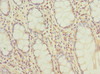 Immunohistochemistry of paraffin-embedded human colon cancer using CSB-PA719420DSR2HU at dilution of 1:100