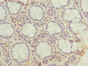 Immunohistochemistry of paraffin-embedded human colon cancer using CSB-PA896752ESR2HU at dilution of 1:100