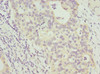 Immunohistochemistry of paraffin-embedded human bladder cancer using CSB-PA892446DSR1HU at dilution of 1:100
