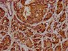 IHC image of CSB-PA892446DSR1HU diluted at 1:348 and staining in paraffin-embedded human pancreatic cancer performed on a Leica BondTM system. After dewaxing and hydration, antigen retrieval was mediated by high pressure in a citrate buffer (pH 6.0) . Section was blocked with 10% normal goat serum 30min at RT. Then primary antibody (1% BSA) was incubated at 4°C overnight. The primary is detected by a biotinylated secondary antibody and visualized using an HRP conjugated SP system.