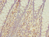 Immunohistochemistry of paraffin-embedded human colon cancer using CSB-PA605995ESR1HU at dilution of 1:100