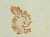 Immunohistochemistry of paraffin-embedded human breast cancer using CSB-PA704858ESR2HU at dilution of 1:100
