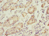 Immunohistochemistry of paraffin-embedded human gastric cancer using CSB-PA622988DSR1HU at dilution of 1:100