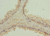 Immunohistochemistry of paraffin-embedded human prostate cancer using CSB-PA019224DSR1HU at dilution of 1:100