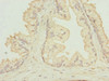 Immunohistochemistry of paraffin-embedded human prostate cancer using CSB-PA019657ESR1HU at dilution of 1:100