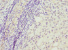Immunohistochemistry of paraffin-embedded human liver cancer using CSB-PA884624DSR2HU at dilution of 1:100