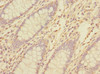 Immunohistochemistry of paraffin-embedded human colon cancer using CSB-PA023960ESR2HU at dilution of 1:100