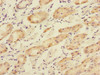 Immunohistochemistry of paraffin-embedded human gastric cancer using CSB-PA617901ESR1HU at dilution of 1:100