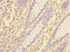 Immunohistochemistry of paraffin-embedded human colon cancer using CSB-PA847679ESR1HU at dilution of 1:100