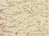 Immunohistochemistry of paraffin-embedded human gastric cancer using CSB-PA847679ESR1HU at dilution of 1:100