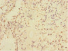 Immunohistochemistry of paraffin-embedded human breast cancer using CSB-PA837850ESR1HU at dilution of 1:100
