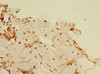 Immunohistochemistry of paraffin-embedded human breast cancer using CSB-PA818276ESR2HU at dilution of 1:100