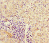 Immunohistochemistry of paraffin-embedded human liver cancer using CSB-PA835697ESR1HU at dilution of 1:100