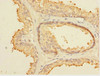 Immunohistochemistry of paraffin-embedded human prostate cancer using CSB-PA891540ESR1HU at dilution of 1:100