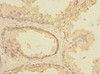 Immunohistochemistry of paraffin-embedded human prostate cancer using CSB-PA891540ESR2HU at dilution of 1:100