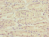 Immunohistochemistry of paraffin-embedded human gastric cancer using CSB-PA883433ESR1HU at dilution of 1:100
