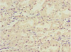 Immunohistochemistry of paraffin-embedded human gastric cancer using CSB-PA883433ESR2HU at dilution of 1:100