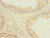 Immunohistochemistry of paraffin-embedded human prostate cancer using CSB-PA013011ESR1HU at dilution of 1:100