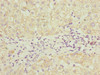 Immunohistochemistry of paraffin-embedded human liver cancer using CSB-PA871560ESR1HU at dilution of 1:100