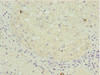 Immunohistochemistry of paraffin-embedded human liver cancer using CSB-PA613596ESR2HU at dilution of 1:100