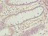 Immunohistochemistry of paraffin-embedded human colon cancer using CSB-PA874802ESR1HU at dilution of 1:100