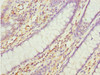 Immunohistochemistry of paraffin-embedded human colon cancer using CSB-PA874802ESR2HU at dilution of 1:100