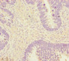Immunohistochemistry of paraffin-embedded human ovarian cancer using CSB-PA007412ESR2HU at dilution of 1:100