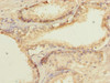 Immunohistochemistry of paraffin-embedded human prostate cancer using CSB-PA010000ESR1HU at dilution of 1:100