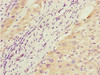 Immunohistochemistry of paraffin-embedded human liver cancer using CSB-PA010000ESR1HU at dilution of 1:100