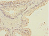 Immunohistochemistry of paraffin-embedded human prostate cancer using CSB-PA010000ESR2HU at dilution of 1:100